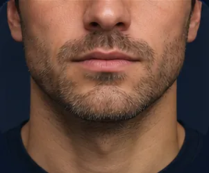 Stubble