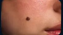 Birthmark