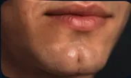 Dimpled Chin