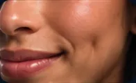 Dimples