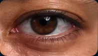 Eye Bags