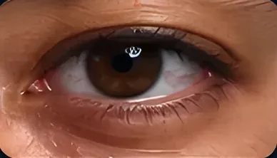 Bolsas sob os olhos