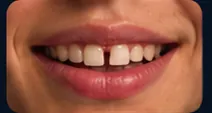 Gap Teeth