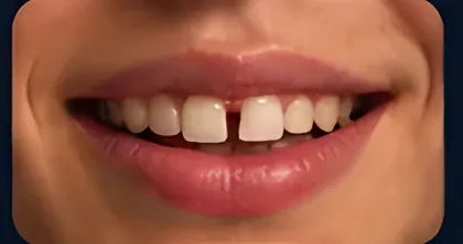 Diastema