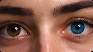 Heterocromia