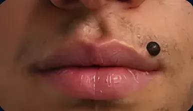 Pinta / sinal de beleza