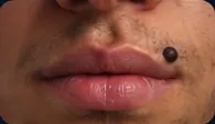 Mole / Beauty Mark