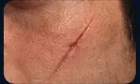 Scar