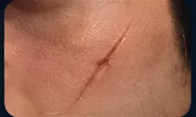 Cicatriz