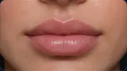 Full Lower Lip