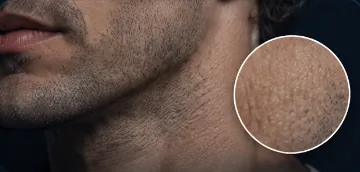 Goosebumps